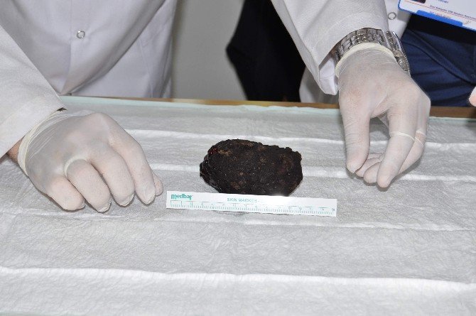 16 Yaşındaki Kızın Midesinden 190 Gram Taş Çıktı