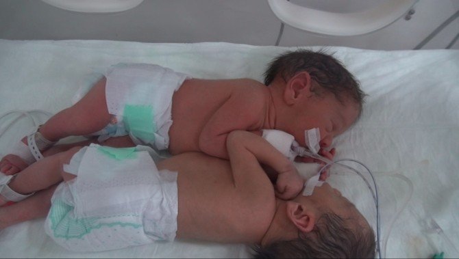Siyam İkizleri Başarılı Ameliyatla Ayrıldı