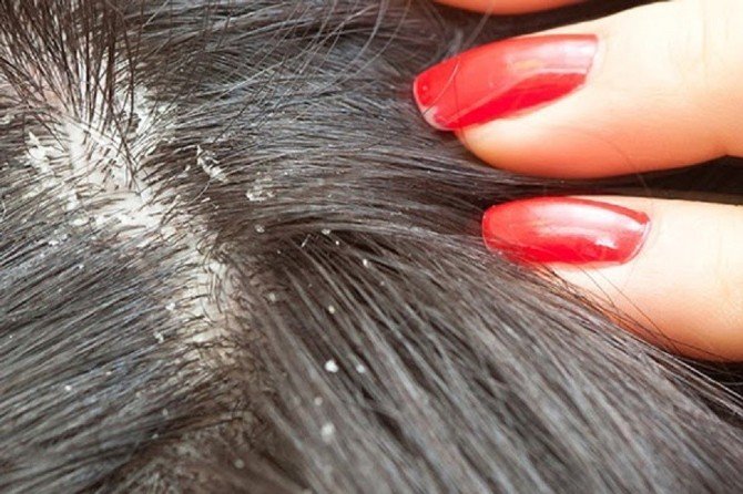 Az Su İçmek Kepeğe De Sebep Oluyor