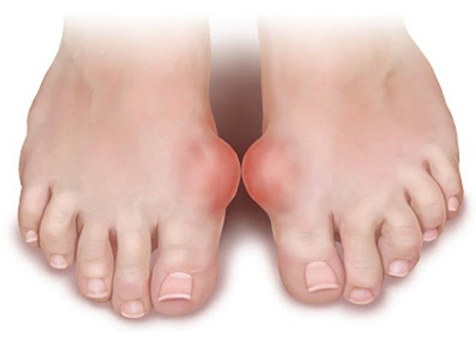 Gut Hastalığı Hakkında Bilgilendirici Açıklama