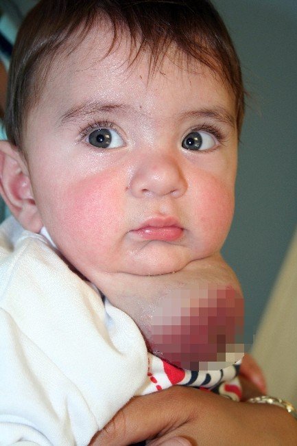 Pişik Zannettiler, Yumurta Büyüklüğünde Damar Yumağı Çıktı