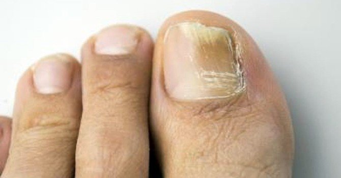 Tırnak Mantarından Lazerle Kurtulmak Mümkün