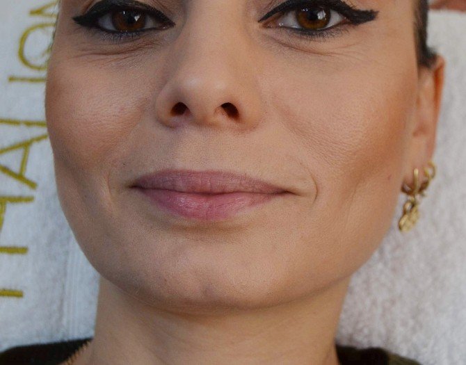 Bin 800 Kilometre Uzaklıktan Dudak Estetiği İçin Trabzon’a Geldi