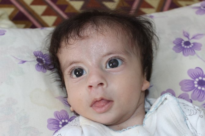 Kulakları Olmayan Bebek Ameliyat Olmayı Bekliyor