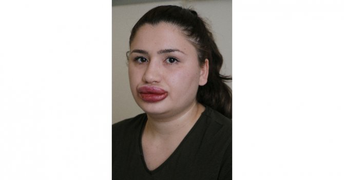 Slikon Mağduru Hemşire Konuştu: Çok Korkuyorum