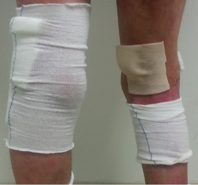 Bu Hastalığın Dünyada Tam Tedavisi Yok