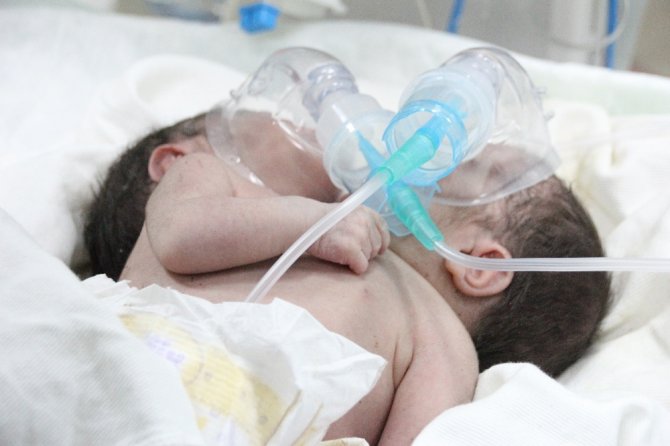 Suriye’de Çift Başlı Bebek Dünyaya Geldi