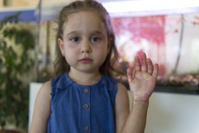 Minik İlkim Hira’nın Tek Umudu İlik Nakli