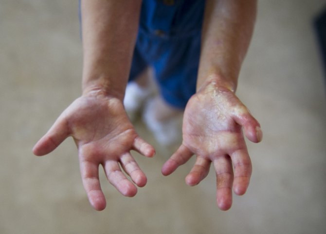 Minik İlkim Hira’nın Tek Umudu İlik Nakli