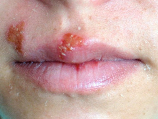 Uçuk Deyip Geçmeyin