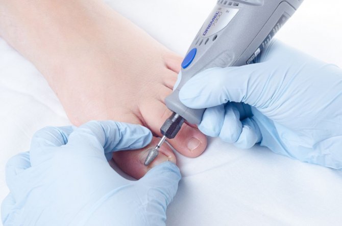 Tırnak Batmasında Uygulanan Yanlış Yöntemlere Dikkat