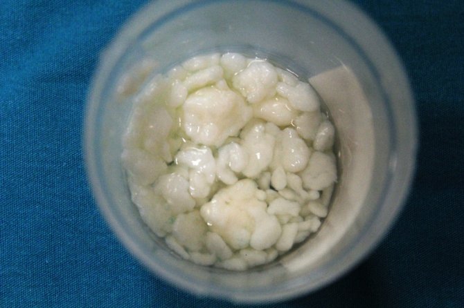 Dizlerinden 967 Adet Eklem Faresi Çıktı