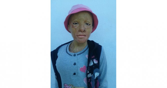 Yeni Bir Yüz Umuduyla Yaşıyor