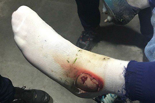 Fenerbahçe Hasan Ali Kaldırım’ın Ayağının Fotoğrafını Paylaştı.
