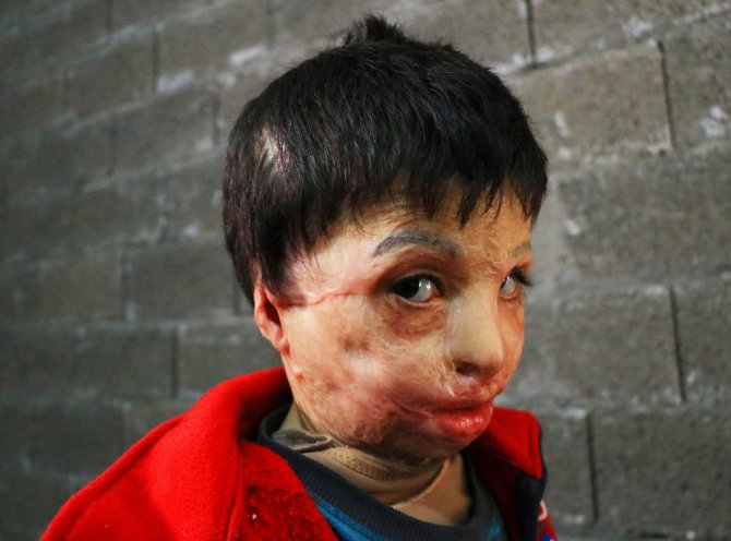 Esad’ın Varil Bombası 7 Yaşındaki Mahmud’u Yaktı