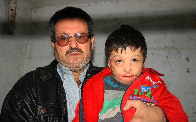 Esad’ın Varil Bombası 7 Yaşındaki Mahmud’u Yaktı