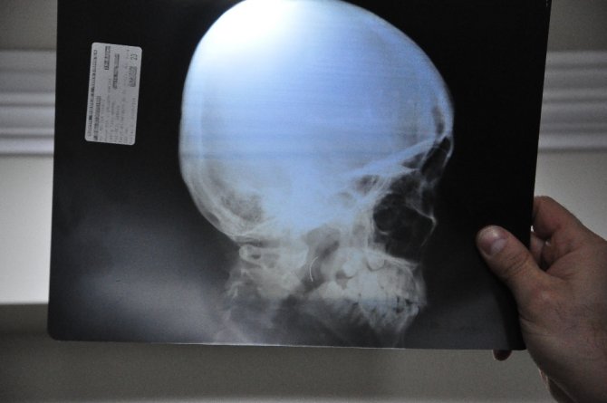 Boğazındaki İğneyle Tam 18 Yıl Yaşadı