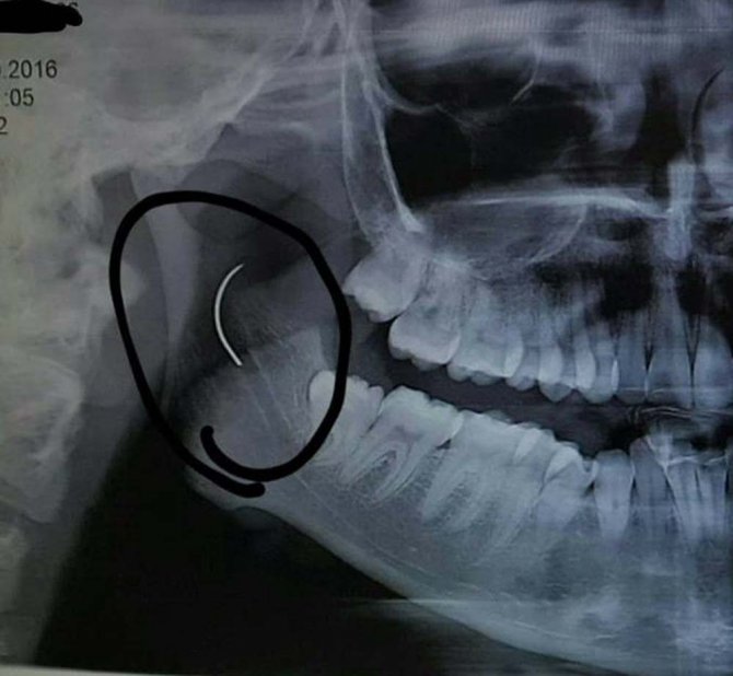 Boğazındaki İğneyle Tam 18 Yıl Yaşadı