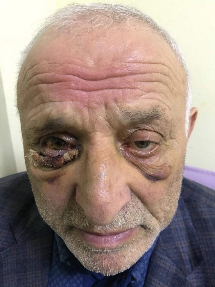 Dünyada Nadir Yapılan Bir Göz Kapağı Operasyonu Trabzon’da Uygulandı