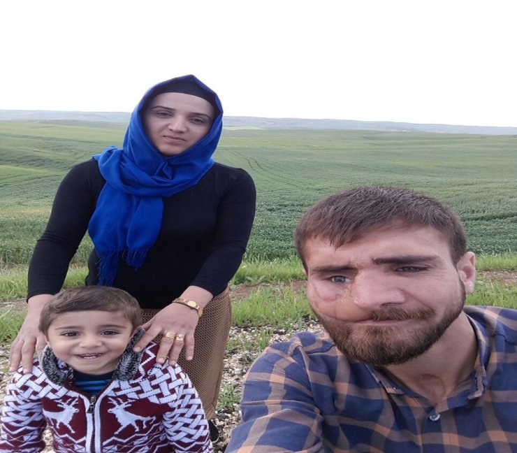 38 Kez Ameliyat Oldu, Yüzü Düzelmedi