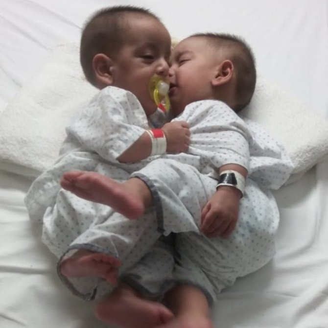 Pakistan’da 9 Aylık Yapışık İkizler Ameliyatla Ayrıldı