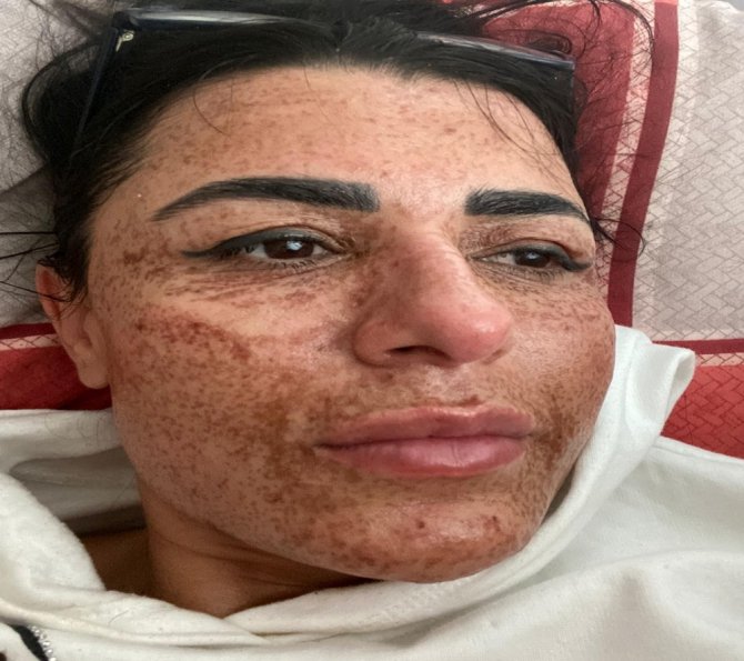 Sosyal Medyada Gördüğü Cilt Toparlama İlanıyla Hayatı Kabusa Döndü