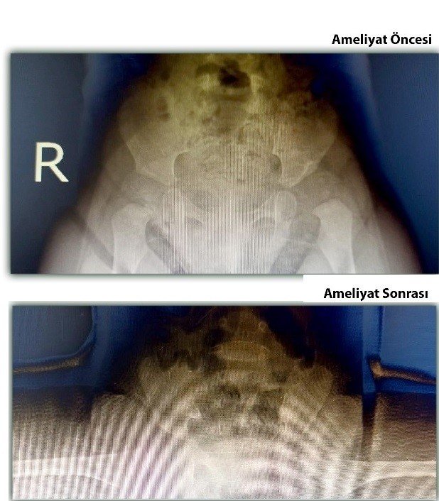 Doğuştan Kalça Çıkığı Olan 11 Aylık Kız Bebeği Sağlığına Kavuştu
