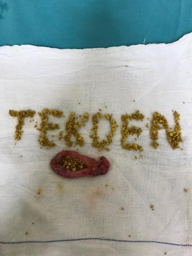 Safra Kesesi Ameliyatından Çıkan Yüzlerce Taşla Tekden Yazdı