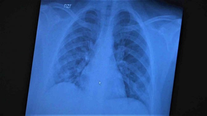 Koronaya Yakalanan 15 Yaş Altı Çocuklarda Ciddi Akciğer Tutulumları