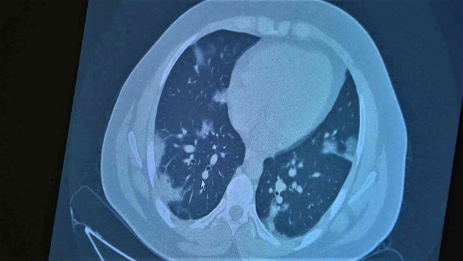 Koronaya Yakalanan 15 Yaş Altı Çocuklarda Ciddi Akciğer Tutulumları