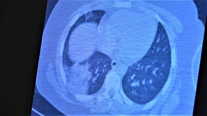 Koronaya Yakalanan 15 Yaş Altı Çocuklarda Ciddi Akciğer Tutulumları