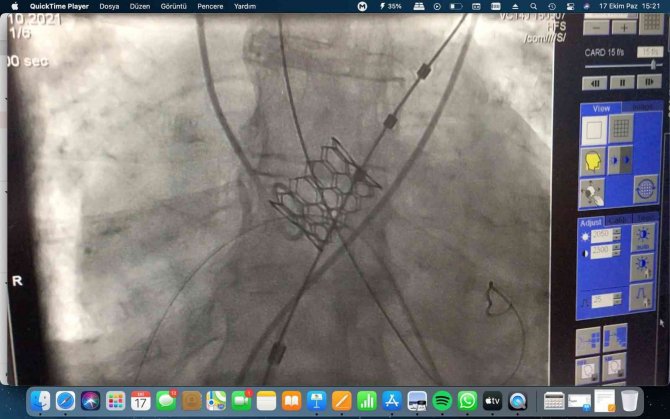 Kütahya’da 88 Yaşındaki Hastanın Aort Kapağı Ameliyatsız Değiştirildi