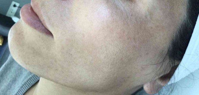 Cilt Lekeleri Doğru Uygulamalarla Kısa Sürede Kabus Olmaktan Çıkıyor