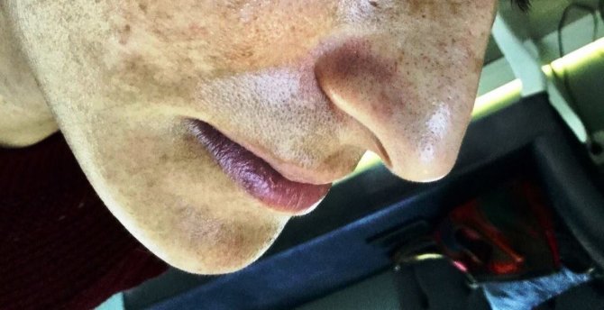 Cilt Lekeleri Doğru Uygulamalarla Kısa Sürede Kabus Olmaktan Çıkıyor