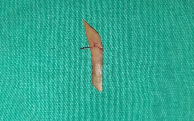 Yemek Borusunu Delen Cismin Turp Olduğunu Zannetti, Gerçek Sonradan Ortaya Çıktı