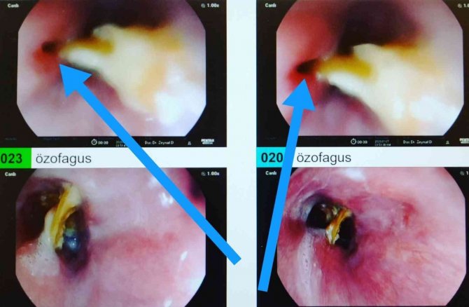 Yemek Borusunu Delen Cismin Turp Olduğunu Zannetti, Gerçek Sonradan Ortaya Çıktı