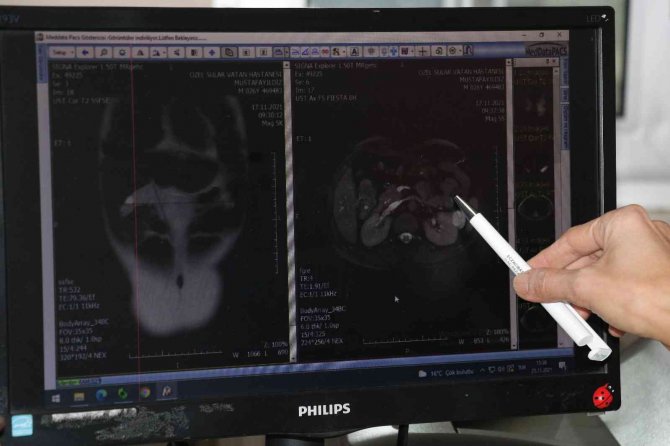 Böbreğinden 3 Santimlik Tümör Çıkarıldı