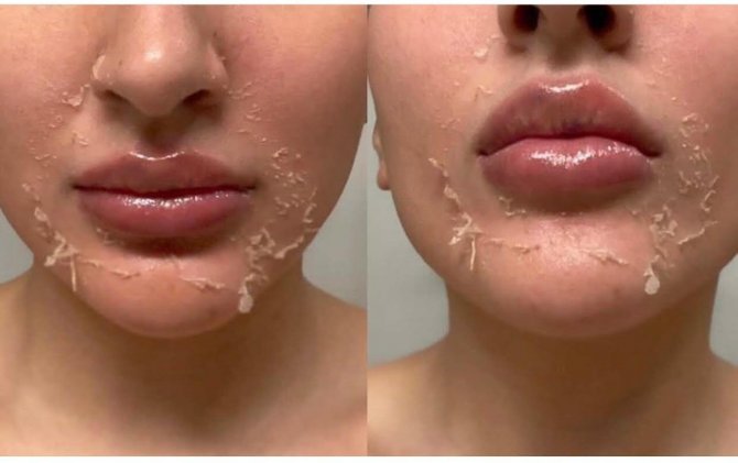 Kış Aylarının En Gözde Peelingi