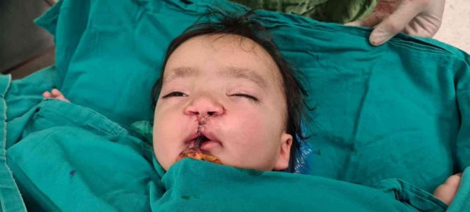 Yarık Damak Ve Dudaklı Bebeğe "Türk Lalesi" Ameliyatı