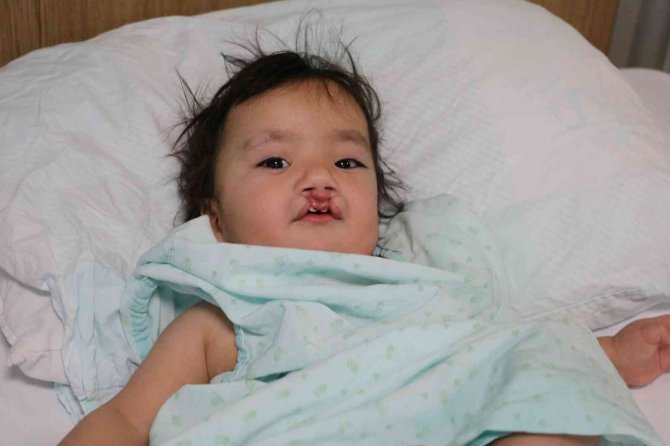 Yarık Damak Ve Dudaklı Bebeğe "Türk Lalesi" Ameliyatı