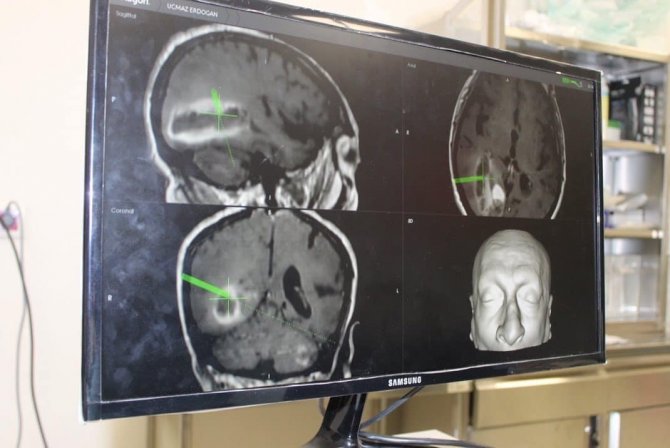 Bilecik’te İlk Kez Nöronavigasyon Sistemi İle Beyin Tümörü Ameliyatı Gerçekleştirildi