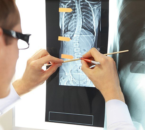 Ebeveynlerin Dikkati Çocuklarda Görülen Skolyozun Önüne Geçiyor