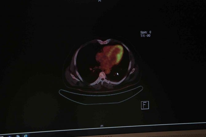 Pandemi Korkusu Erken Teşhisi Engelliyor