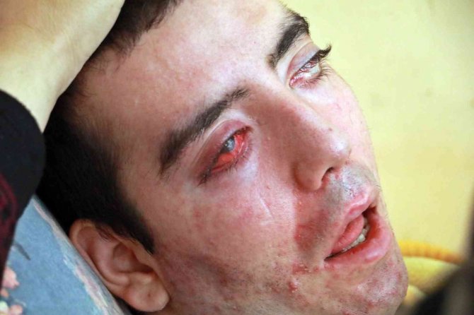 8 Yıldır Gözlerini Kırpamıyor, Adeta Kan Ağlıyor