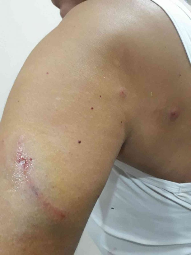 Yürüyüş Yaparken Sokak Köpeklerinin Saldırısına Uğradı