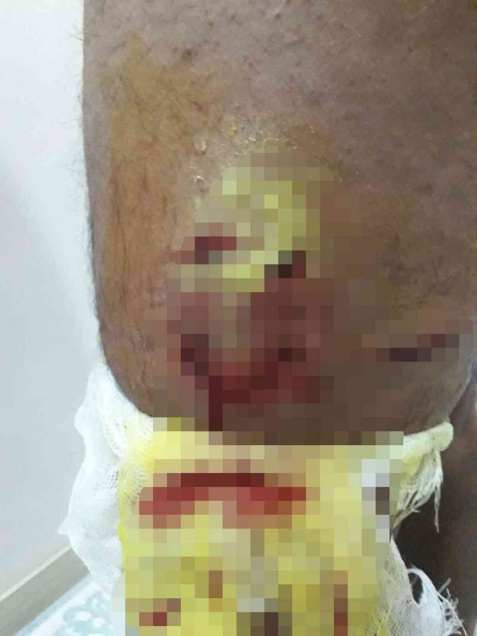 Yürüyüş Yaparken Sokak Köpeklerinin Saldırısına Uğradı