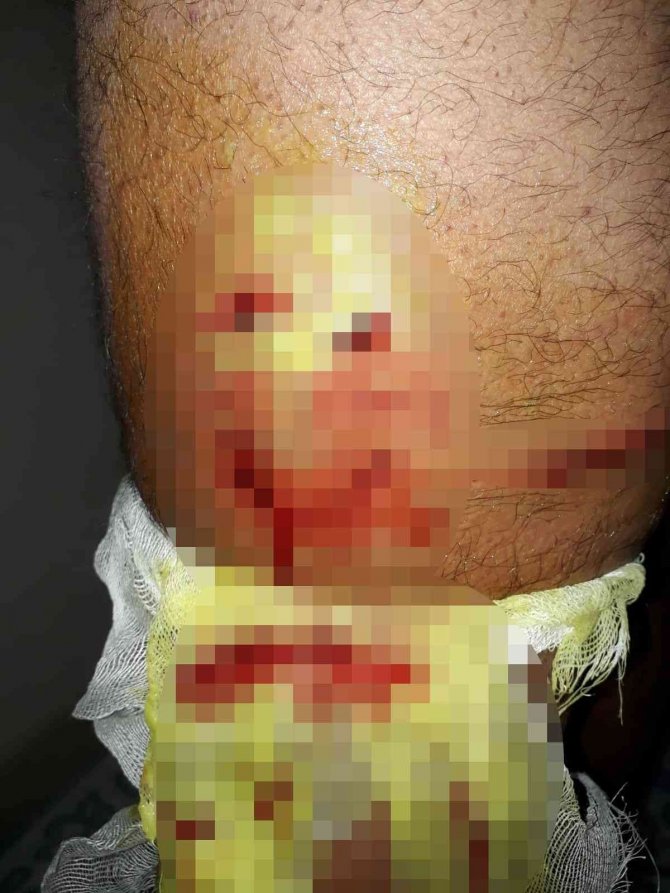 Yürüyüş Yaparken Sokak Köpeklerinin Saldırısına Uğradı