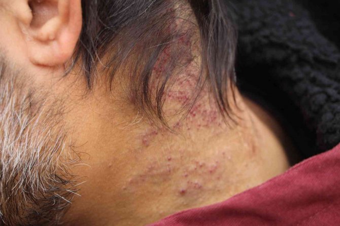 Başında Oluşan Kistten Muzdarip Olan Hastaya 12 Yıldır Teşhis Konulamadı