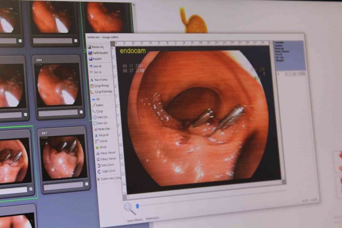 İ̇leri Endoskopik Yöntemle Erken Dönem Mide-bağırsak Kanserinde Yüzde 100 Başarı