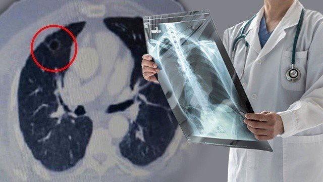 Covid’den Yıpranan Akciğerleri Güçlendirici Nefes Egzersizleri